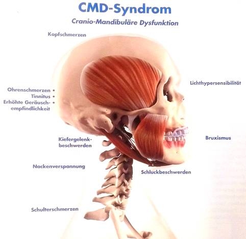 CMD-Syndrom