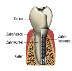 Schema Zahn-Implantat